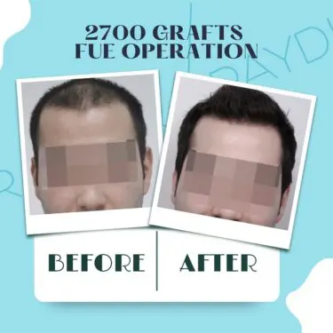 Hair transplantation