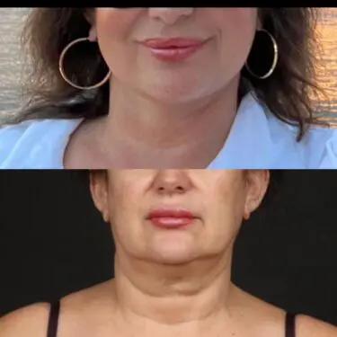 Facelift & neck lifting