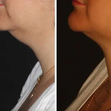 Facelift & neck lifting