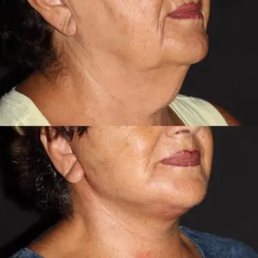 Facelift & neck lifting