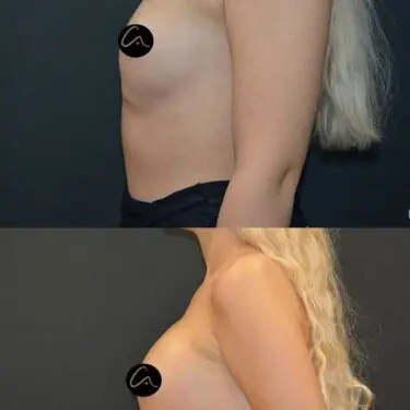 Mammoplastik