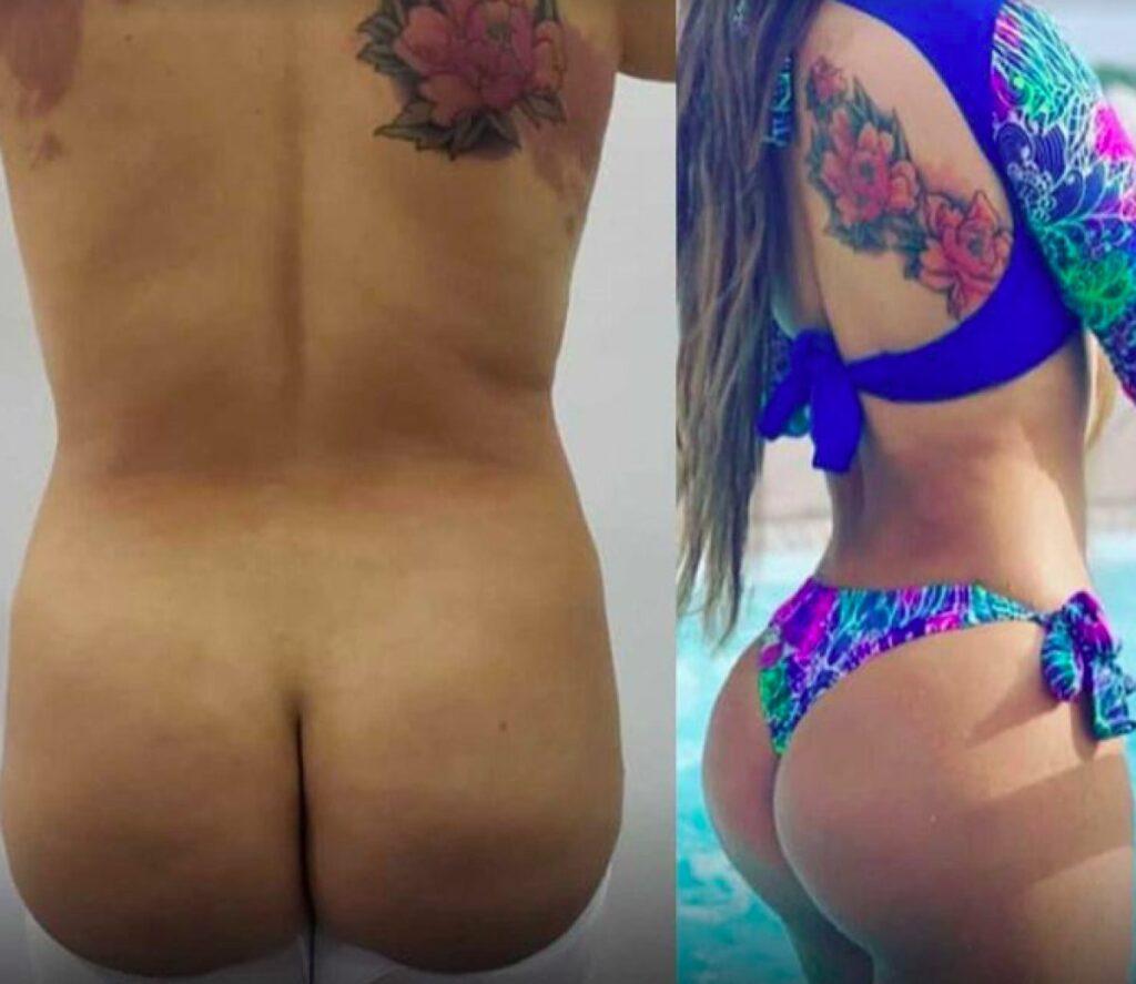 Liposuction, Brazilian butt lift (BBL)