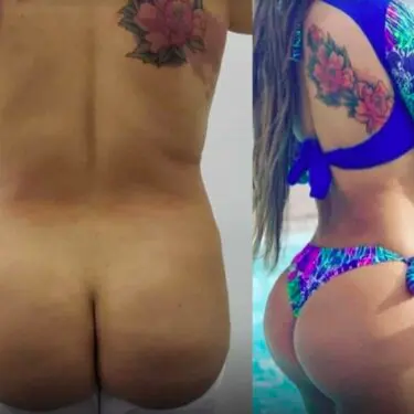 Fettabsaugung, Brazilian Butt Lift (BBL)
