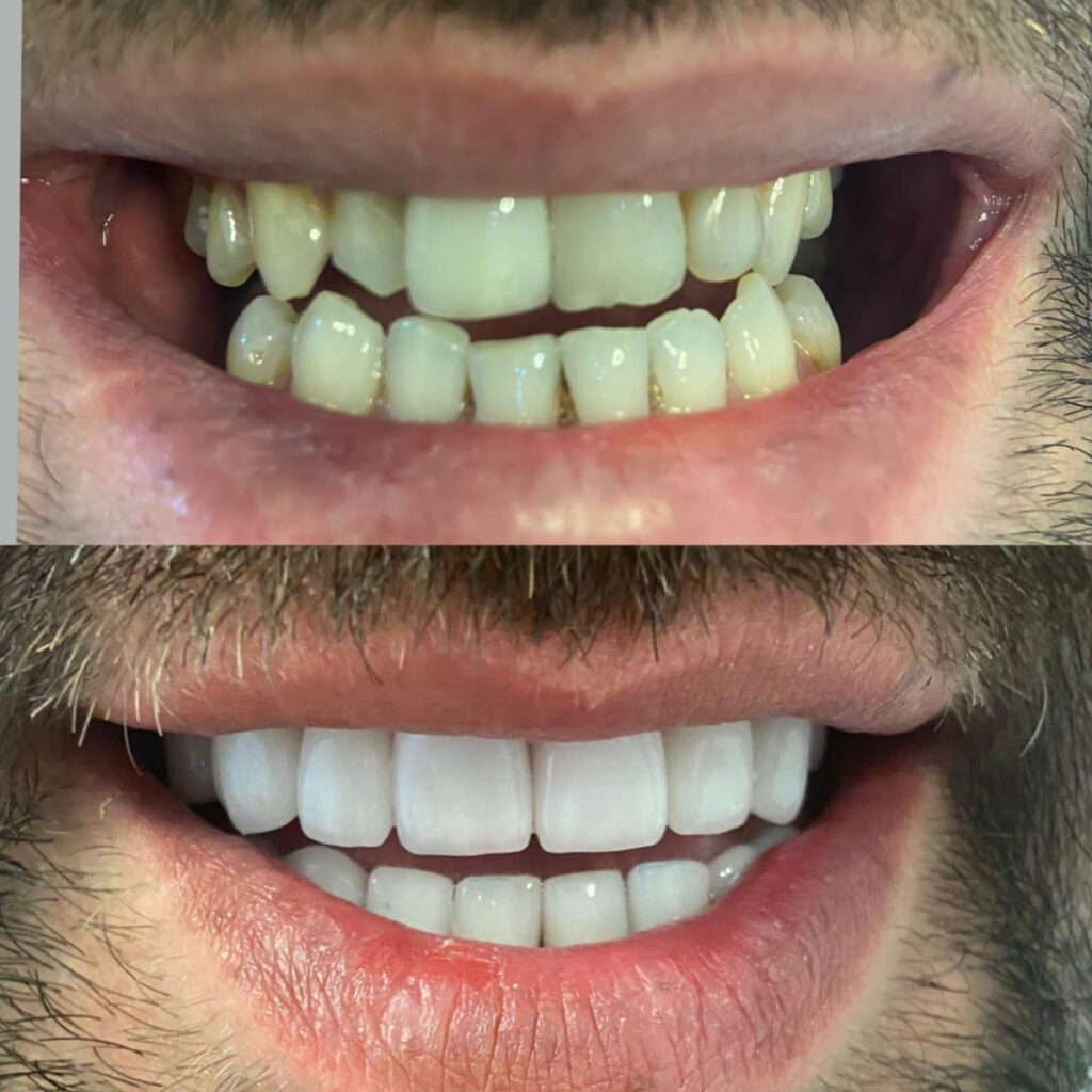 Dental implants in Turkey