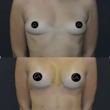 Mammoplastik