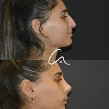 Rhinoplastik