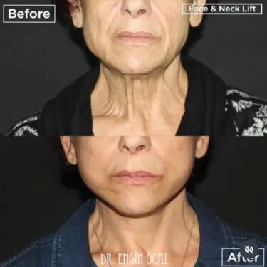 Facelift & neck lifting
