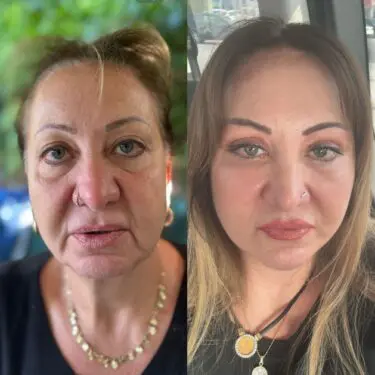 Facelift & neck lifting