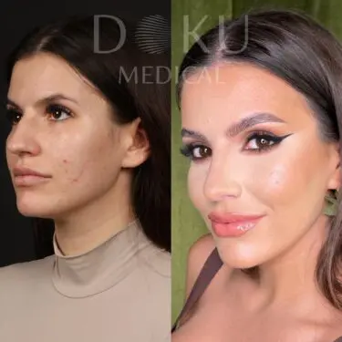 Facelift & neck lifting