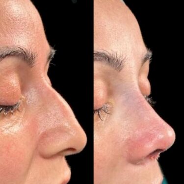 Rhinoplasty 
