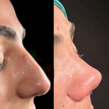 Rhinoplasty 