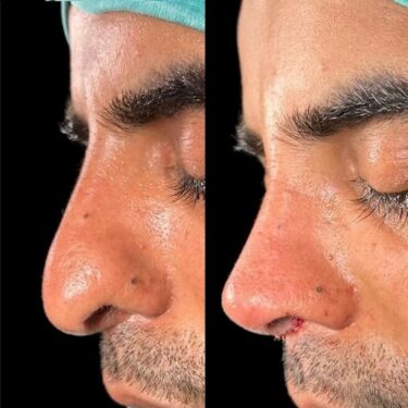Rhinoplastik