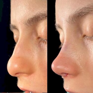 Rhinoplastik