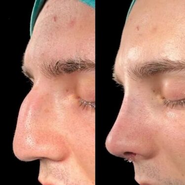 Rhinoplastik
