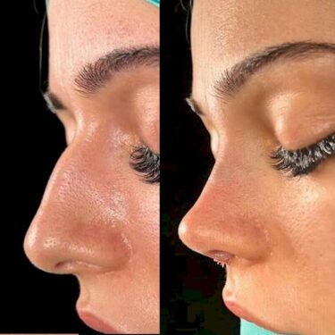Rhinoplasty 