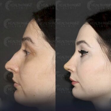 Rhinoplastik