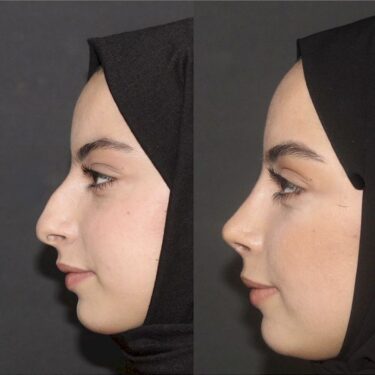 Rhinoplastik