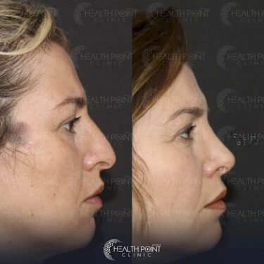 Rhinoplastik