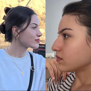 Rhinoplastik