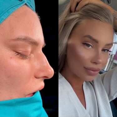 Rhinoplastik