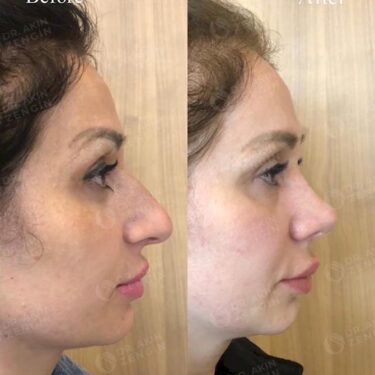 Rhinoplastik