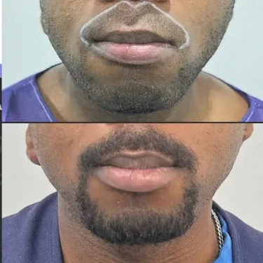 Beard transplantation in Turkey