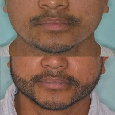 Beard transplantation in Turkey