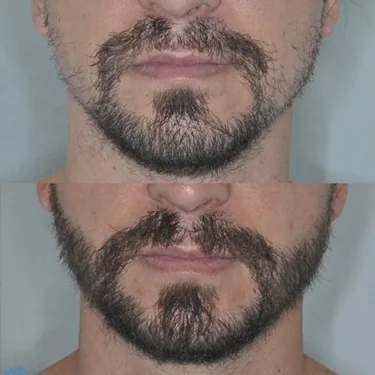 Beard transplantation in Turkey