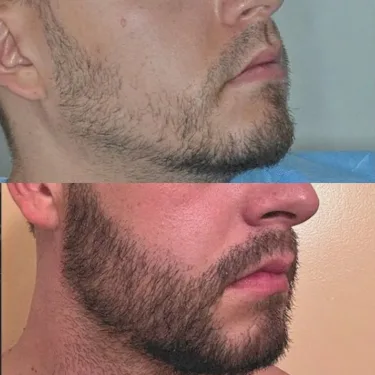 Beard transplantation in Turkey