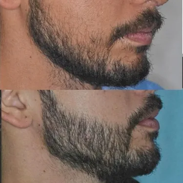 Beard transplantation in Turkey