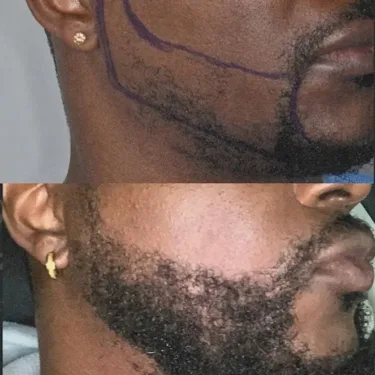 Beard transplantation in Turkey