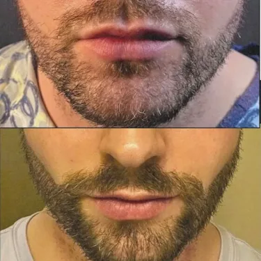 Beard transplantation in Turkey