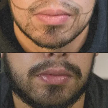 Beard transplantation in Turkey