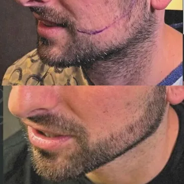 Beard transplantation in Turkey