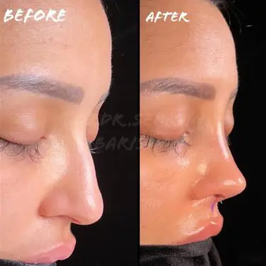 Rhinoplastik