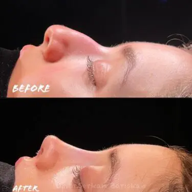 Rhinoplastik