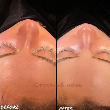 Rhinoplastik