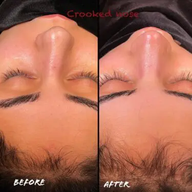 Rhinoplastik