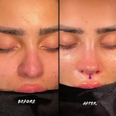 Rhinoplastik