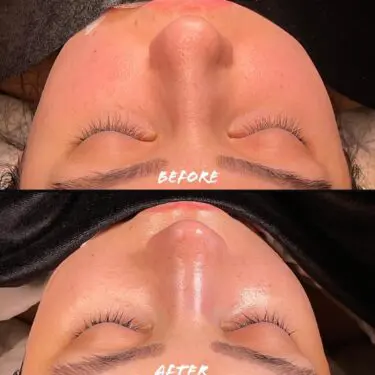 Rhinoplastik