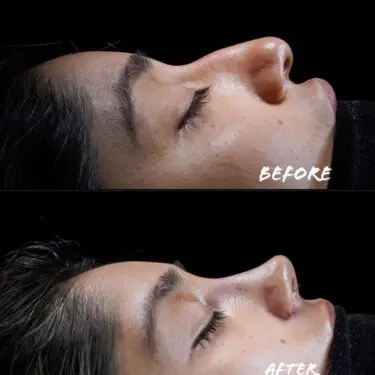 Rhinoplastik