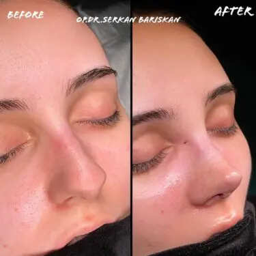 Rhinoplastik