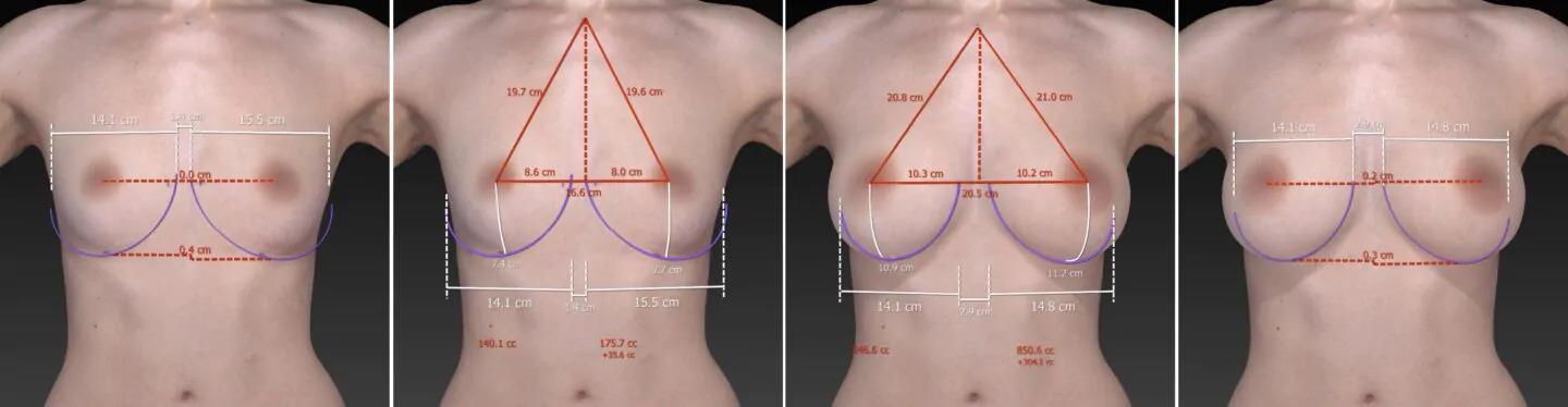 Типы увеличения груди