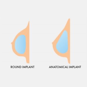 anatomical breast implants