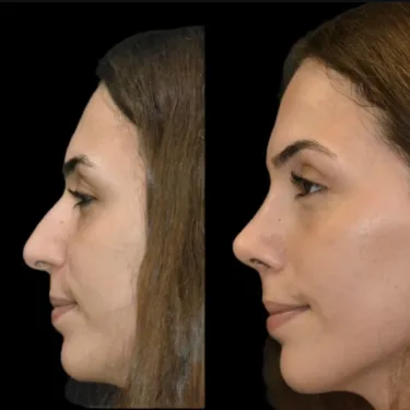 Rhinoplastik