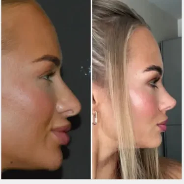 Rhinoplastik