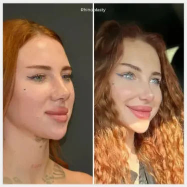 Rhinoplastik