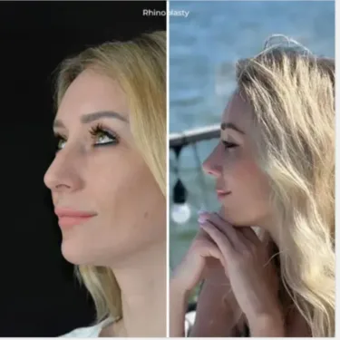 Rhinoplastik