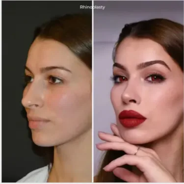 Rhinoplastik