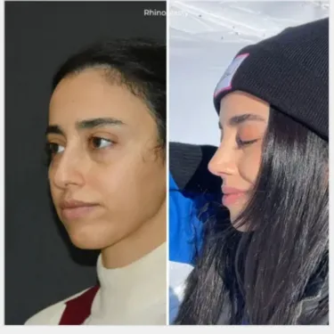 Rhinoplastik